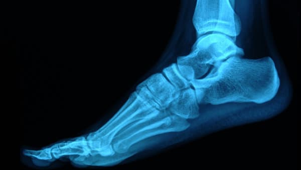 Foot X-Ray